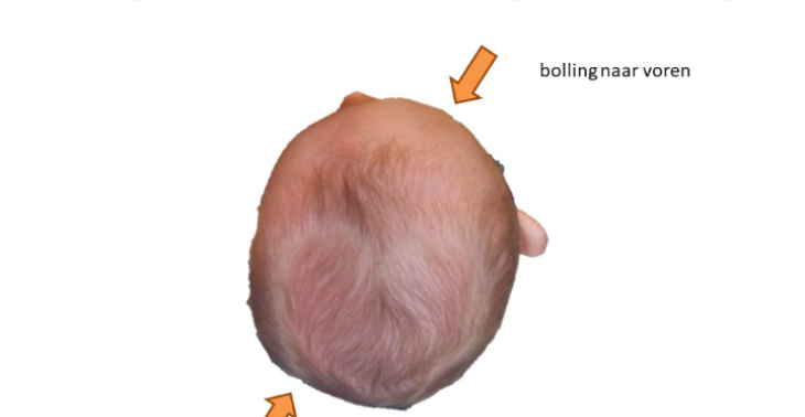 Redressiehelm therapie baby