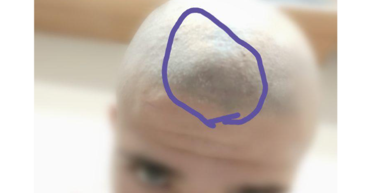 Verwijdering van een kankergezwel uit het hoofd.