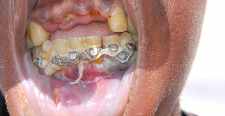 medische noodhulp tandzorgen voor Alasan Jaw  in Gambia -