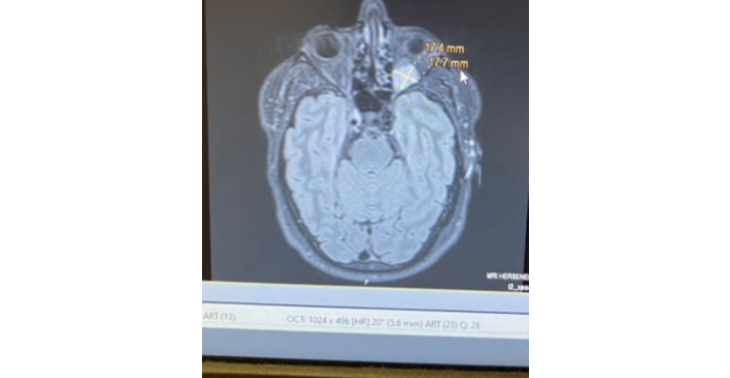 Tumor